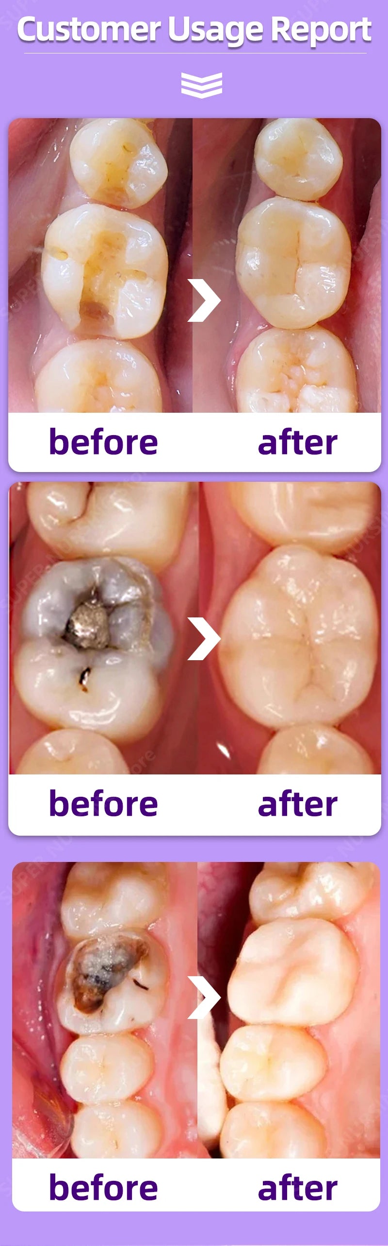Anti Caries Tooth Decay Healing Cavities